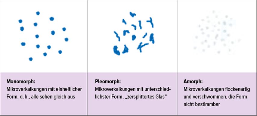 Zysten und Kalzifikationen in der Mamma - Gynäkologie & Geburtshilfe